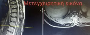 Χειρουργική Αφαίρεση Μηνιγγιώματος – Κλινική Περίπτωση Χειρουργικής Θωρακικής Μοίρας Σπονδυλικής Στήλης 1 Χειρουργική Αφαίρεση Μηνιγγιώματος - Κλινική Περίπτωση Χειρουργικής Θωρακικής Μοίρας Σπονδυλικής Στήλης 1
