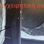 Χειρουργική Αφαίρεση Μηνιγγιώματος - Κλινική Περίπτωση Χειρουργικής Θωρακικής Μοίρας Σπονδυλικής Στήλης 2 Χειρουργική Αφαίρεση Μηνιγγιώματος - Κλινική Περίπτωση Χειρουργικής Θωρακικής Μοίρας Σπονδυλικής Στήλης 2